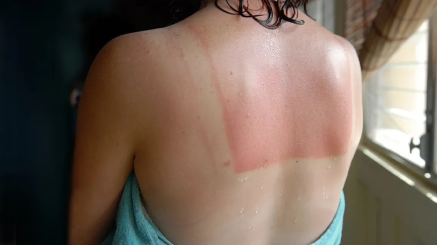 The Shocking “Intentional Sunburn” Trend: Why Gen Z Is Risking Their Skin for Social Media